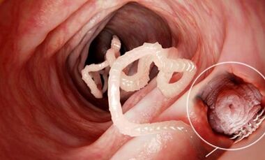 How to recognize the presence of parasites in the human intestine