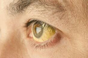 Yellowing of the whites of the eyes
